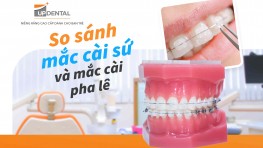 So sánh mắc cài sứ và mắc cài pha lê