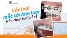 Các loại mắc cài kim loại: Nên chọn loại nào?