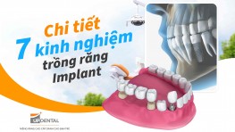 Chi tiết 7 kinh nghiệm trồng răng Implant