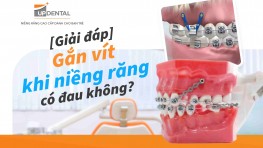 [Giải đáp] Gắn vít khi niềng răng có đau không?