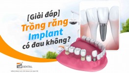 Trồng răng Implant có đau không? Giải đáp thắc mắc từ chuyên gia