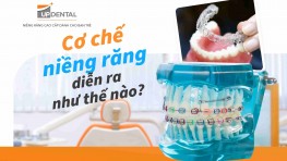 Cơ chế niềng răng diễn ra như thế nào?