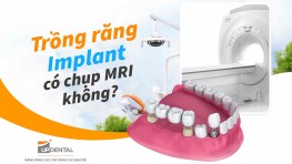 Trồng răng Implant có chụp MRI không?