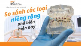 So sánh các loại niềng răng phổ biến hiện nay