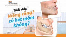 [Giải đáp] Niềng răng có hết móm không?