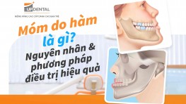 Móm do hàm là gì? Nguyên nhân và phương pháp điều trị hiệu quả 