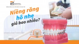 Hô nhẹ có nên niềng răng không? Niềng răng hô nhẹ giá bao nhiêu?