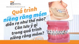 Quá trình niềng răng móm diễn ra như thế nào? Cần lưu ý gì trong quá trình niềng răng móm?