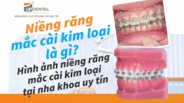 Niềng răng mắc cài kim loại là gì? Hình ảnh niềng răng mắc cài kim loại tại nha khoa uy tín