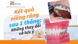 Kết quả niềng răng sau 1 tháng: Những thay đổi và lưu ý