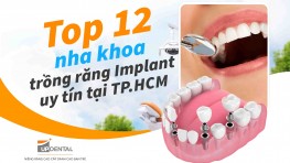 Top 12+ địa chỉ trồng răng Implant uy tín tại TP.HCM