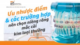 Ưu nhược điểm và các trường hợp nên chọn niềng răng mắc cài kim loại thường