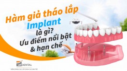 Hàm giả tháo lắp Implant là gì? Ưu điểm nổi bật và hạn chế