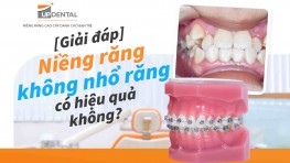 [Giải đáp] Niềng răng không nhổ răng có hiệu quả không? 