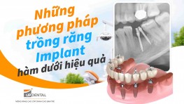 [Cập nhật] - Những phương pháp trồng răng Implant hàm dưới hiệu quả