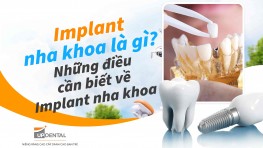 Implant nha khoa là gì? Những điều cần biết về Implant nha khoa