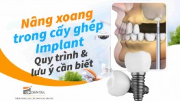 Nâng xoang trong cấy ghép Implant: Quy trình và lưu ý cần biết