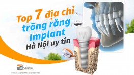 Top 7 địa chỉ trồng răng Implant Hà Nội uy tín