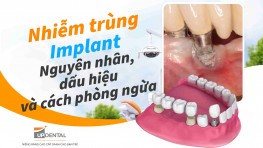 Nhiễm trùng Implant: Nguyên nhân, dấu hiệu và cách phòng ngừa 