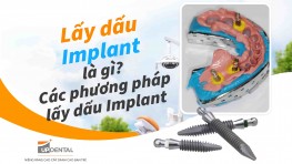 Lấy dấu Implant là gì? Các phương pháp lấy dấu Implant