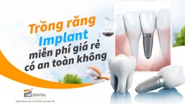 Trồng răng Implant miễn phí có an toàn không