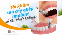 Tái khám sau cấy ghép Implant có cần thiết không?