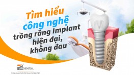 Review trồng răng Implant - Kiến thức quan trọng cần lưu ý