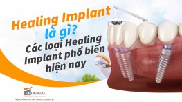 Healing Implant là gì? Các loại Healing Implant phổ biến hiện nay