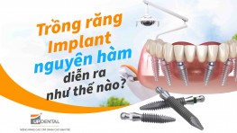 Trồng răng Implant nguyên hàm diễn ra như thế nào?