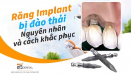 Răng Implant bị đào thải - Nguyên nhân và cách khắc phục