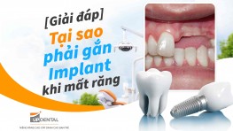 [Giải đáp] Tại sao phải gắn Implant khi mất răng