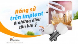 Răng sứ trên Implant và những điều cần lưu ý