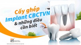 Cấy ghép Implant CBCTVN và những điều cần biết