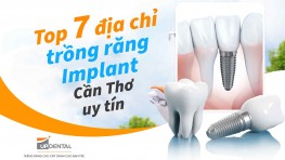 Top 7 địa chỉ trồng răng Implant Cần Thơ uy tín