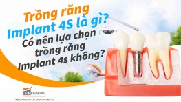 Trồng răng Implant 4S là gì? Có nên lựa chọn không?