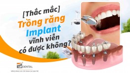 [Giải đáp] - Trồng răng Implant vĩnh viễn có được không?