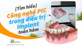 [Tìm hiểu] - Công nghệ PIC trong điều trị Implant toàn hàm
