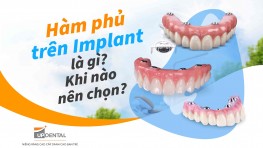 Hàm phủ trên Implant là gì? Khi nào nên chọn hàm phủ trên Implant?