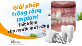 Giải pháp trồng răng Implant tiết kiệm cho người mất răng