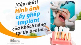 Hình ảnh cấy ghép Implant của Khách hàng tại Up Dental