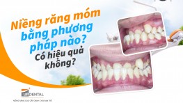 Niềng răng móm bằng phương pháp nào? Có hiệu quả không?