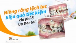 Niềng răng lệch lạc hiệu quả tiết kiệm chi phí ở Up Dental