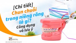 Chun chuỗi trong niềng răng là gì? Công dụng và lưu ý