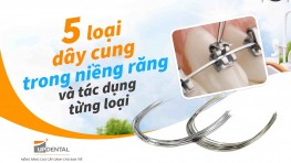 5 loại dây cung trong niềng răng và tác dụng từng loại