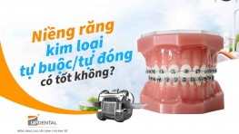 Niềng răng mắc cài kim loại tự buộc/ tự đóng có tốt không?