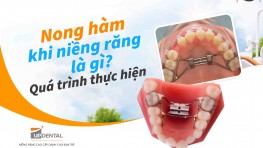 Nong hàm khi niềng răng là gì? Quá trình thực hiện
