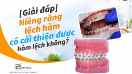 [Giải đáp] Niềng răng lệch hàm có cải thiện được hàm lệch không?