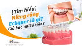 [Tìm hiểu] Niềng răng Ecligner là gì? Giá bao nhiêu tiền?