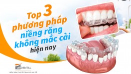 Top 3 phương pháp niềng răng không mắc cài hiện nay