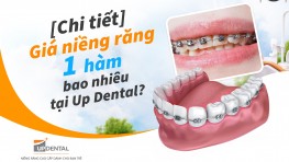 Giá niềng răng 1 hàm bao nhiêu [2026] tại Up Dental
